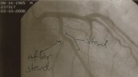 Left Coranary Artery (stent).jpg